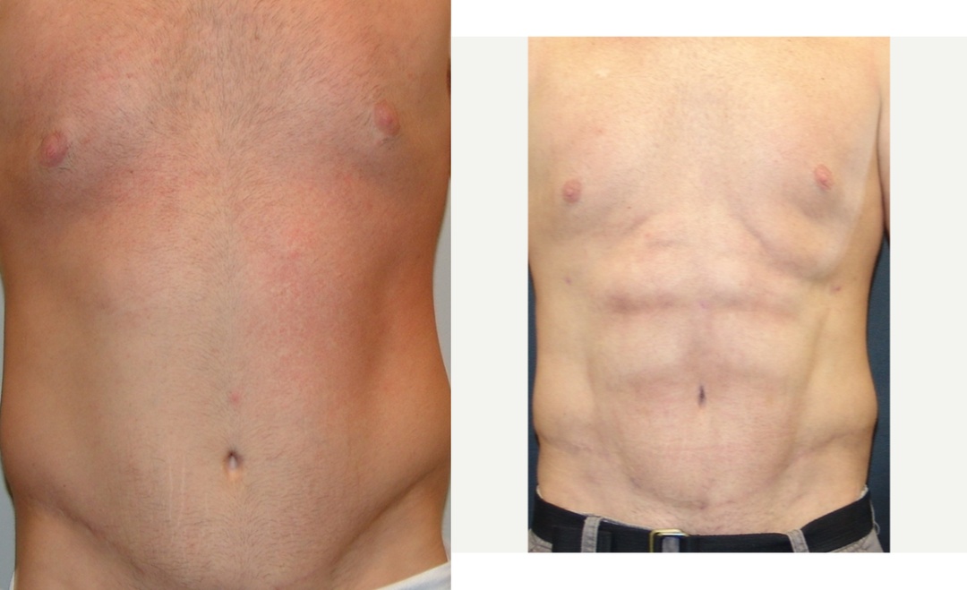 Man treated with Abdominal Etching