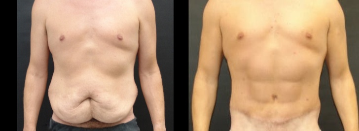 Man treated with Abdominal Etching