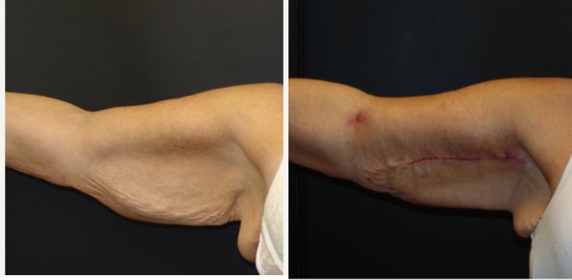 Woman treated with Arm Lift