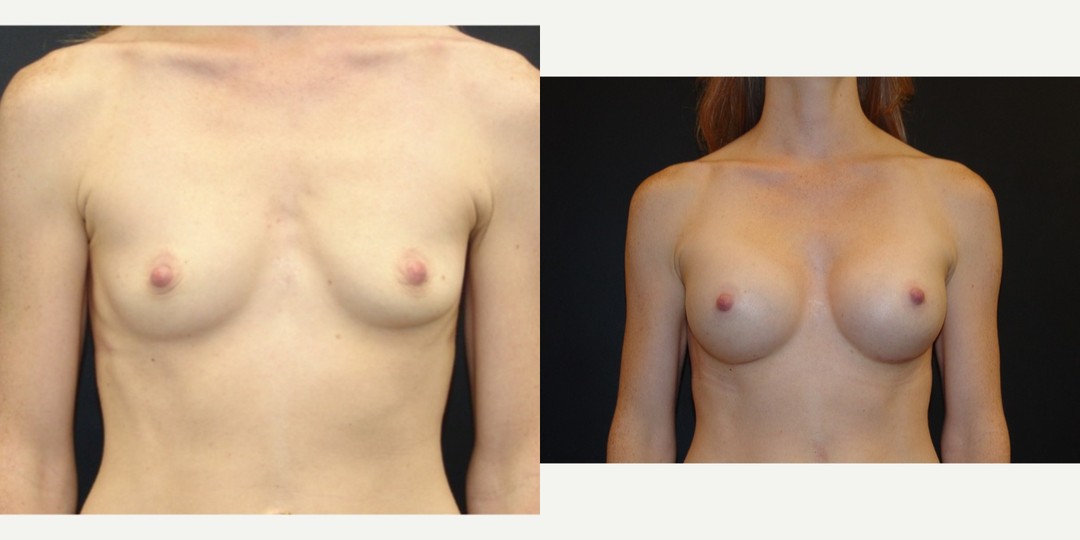 25-34 year old woman treated with Breast Augmentation