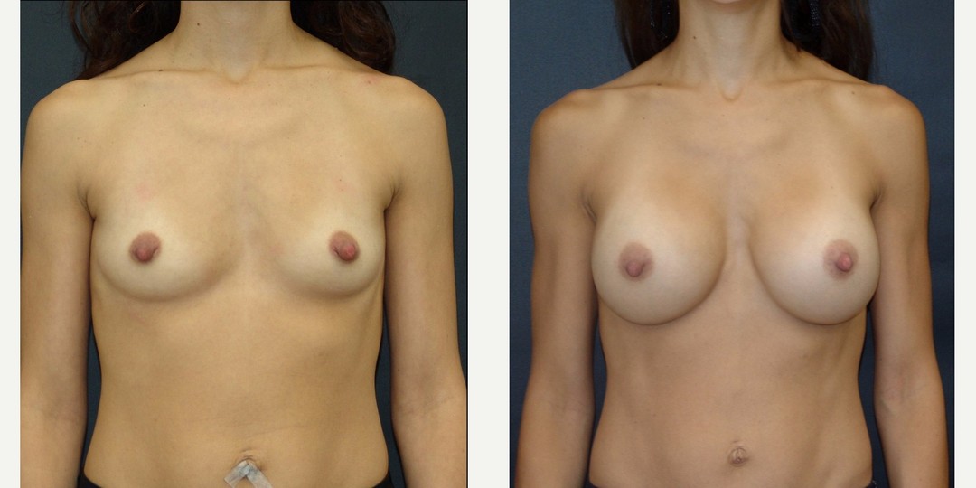 25-34 year old woman treated with Breast Augmentation