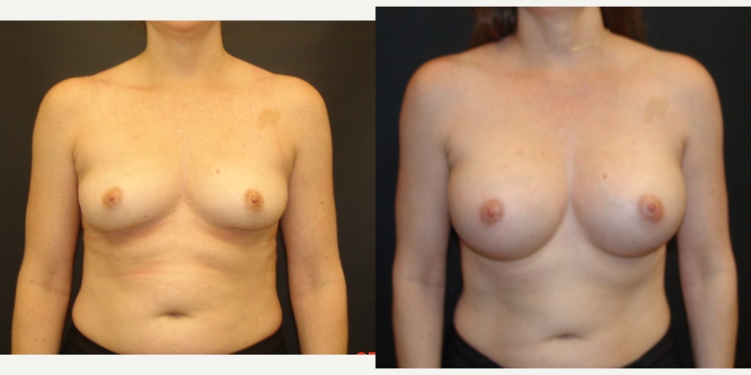 18-24 year old woman treated with Breast Augmentation