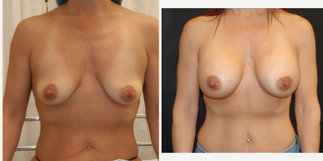 35-44 year old woman treated with Breast Augmentation, considered Breast Lift for moderate ptosis