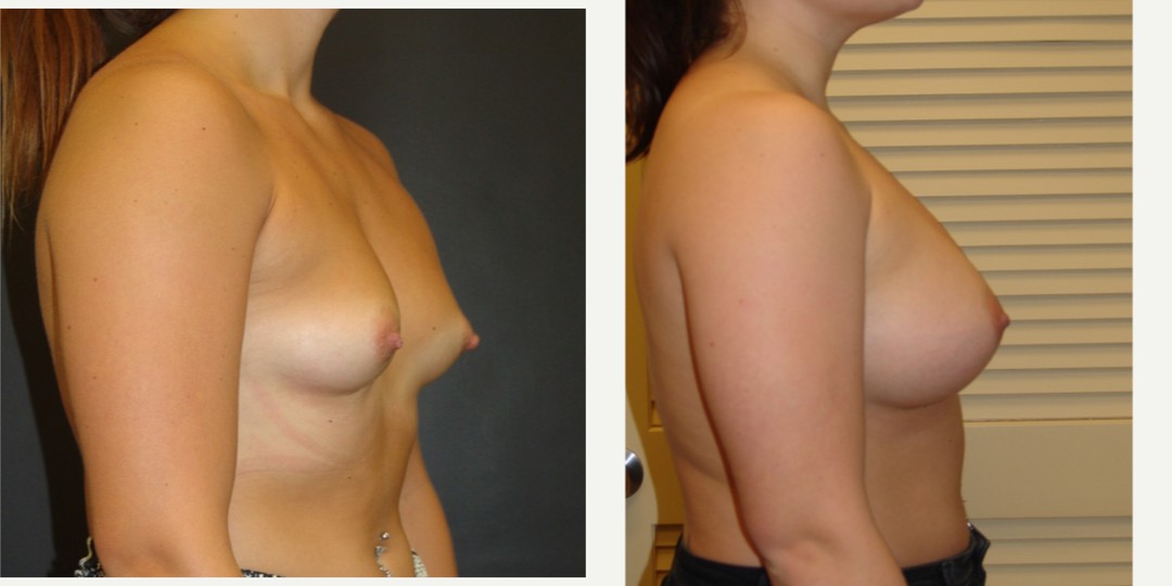 25-34 year old woman treated with Breast Augmentation
