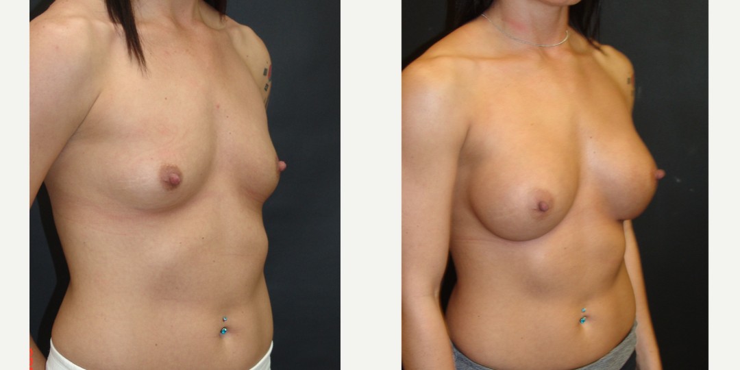 25-34 year old woman treated with Breast Augmentation