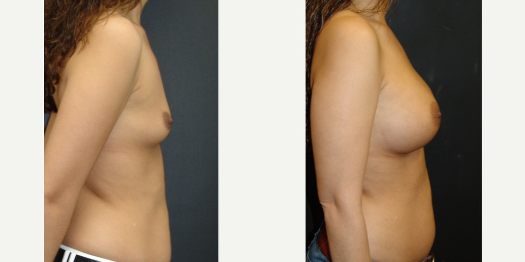 25-34 year old woman treated with Breast Augmentation