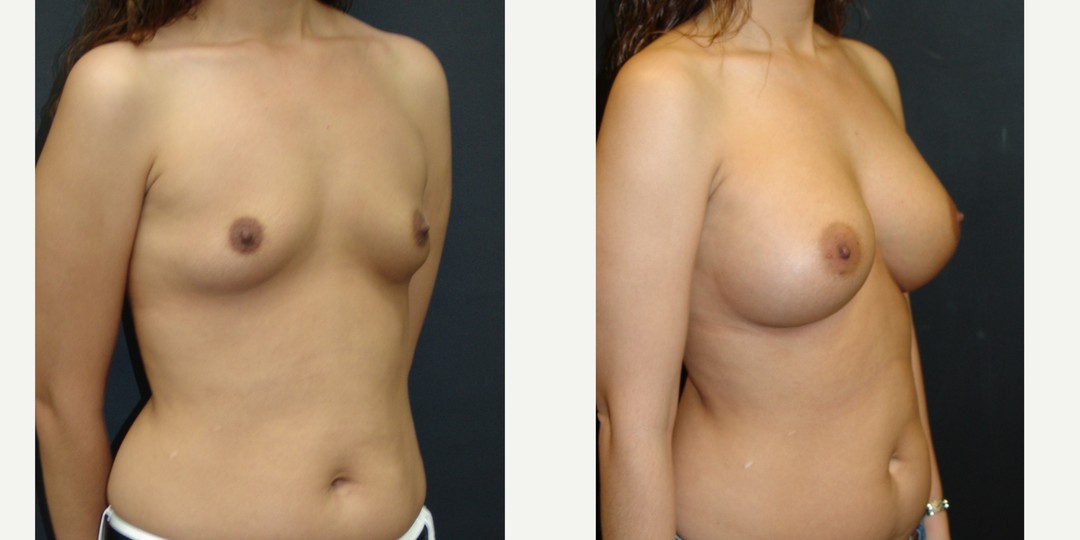 25-34 year old woman treated with Breast Augmentation