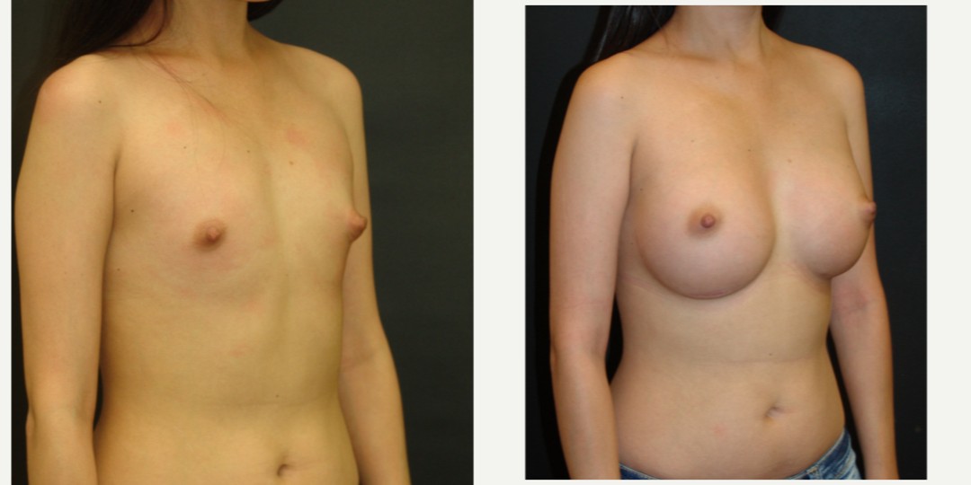 18-24 year old woman treated with Breast Augmentation