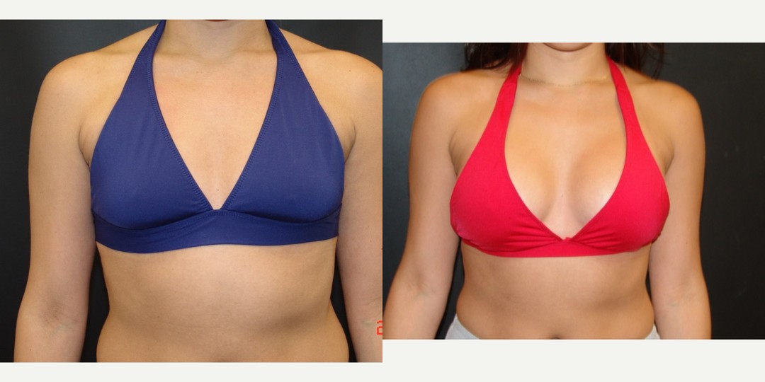 18-24 year old woman treated with Breast Augmentation