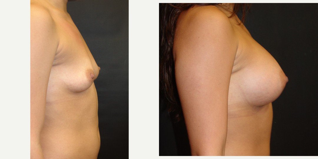 18-24 year old woman treated with Breast Augmentation