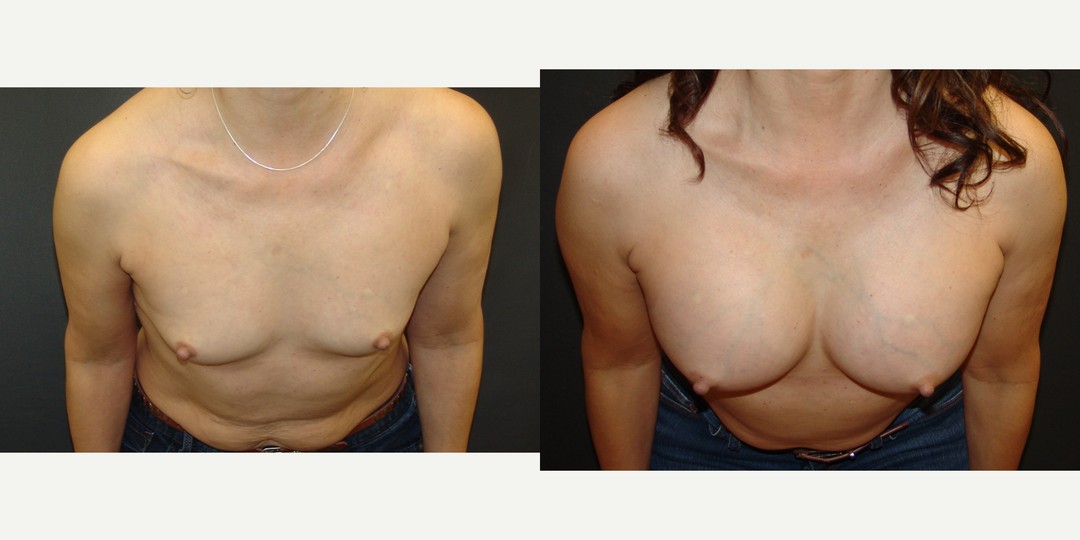 45-54 year old woman treated with Breast Augmentation