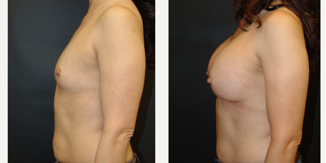 45-54 year old woman treated with Breast Augmentation