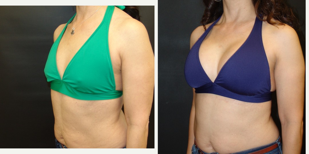 45-54 year old woman treated with Breast Augmentation