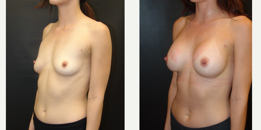 25-34 year old woman treated with Breast Augmentation
