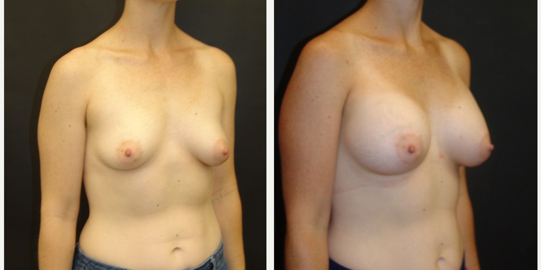 25-35 year old woman treated with Breast Augmentation