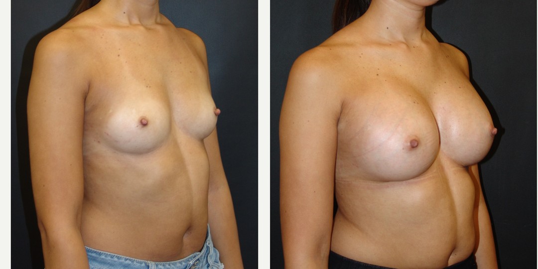 18-24 year old woman treated with Breast Augmentation