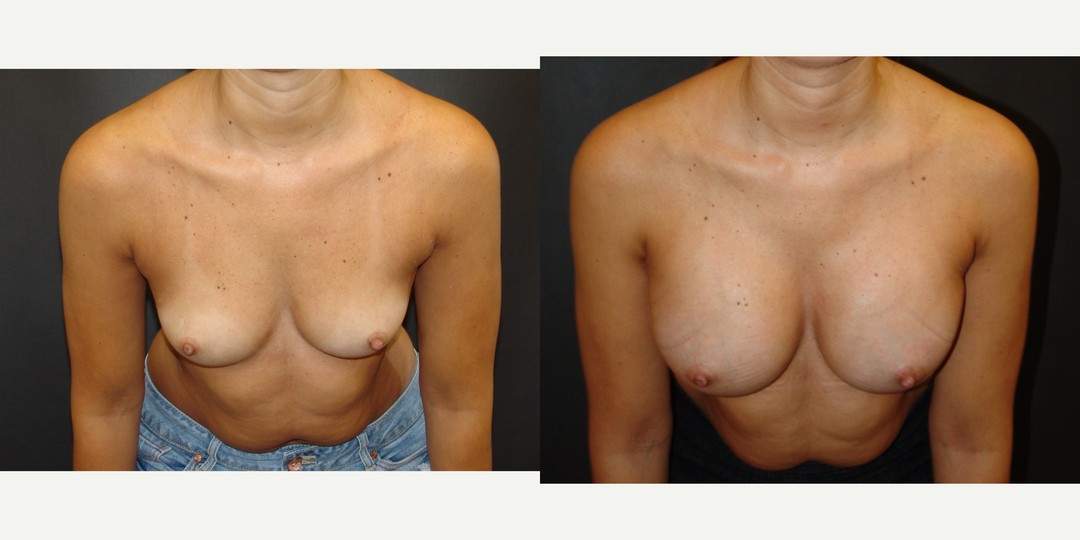 18-24 year old woman treated with Breast Augmentation