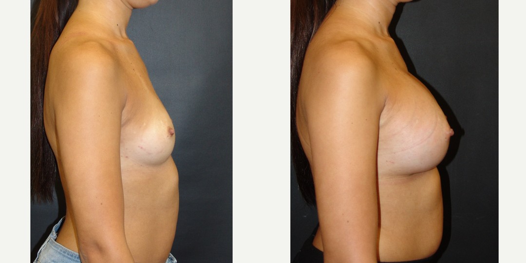 18-24 year old woman treated with Breast Augmentation
