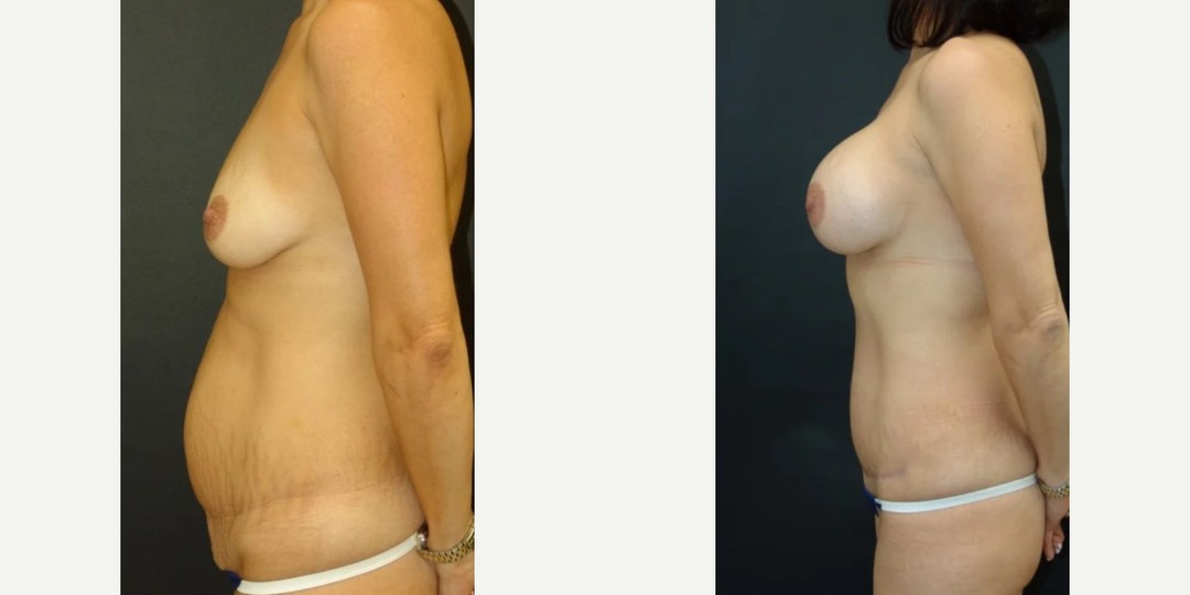 Woman treated with Tummy Tuck, Breast Augmentation