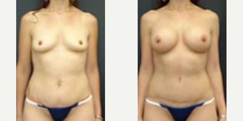 Woman treated with Breast Augmentation, Tummy Tuck