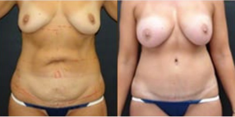 Woman treated with Tummy Tuck, Breast Augmentation