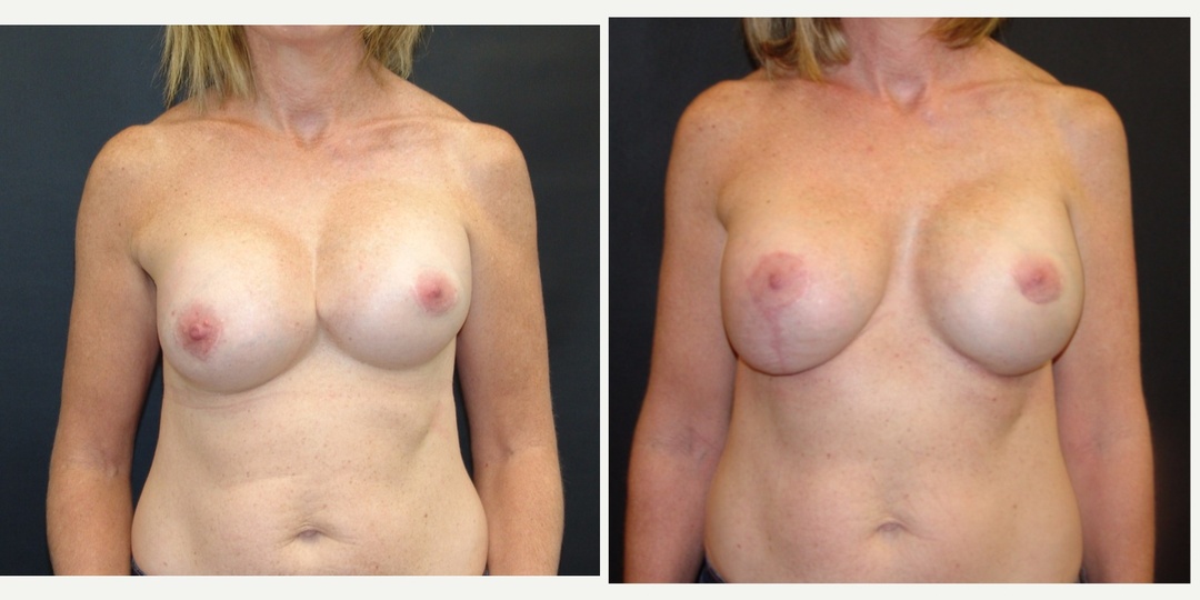 Woman treated with Breast Implant Revision