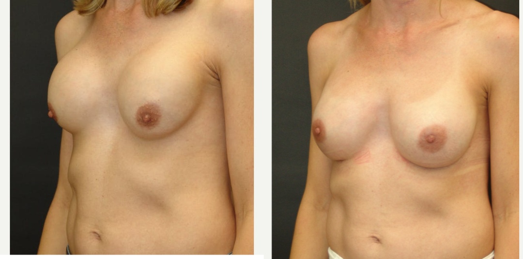 Woman treated with Breast Implant Revision