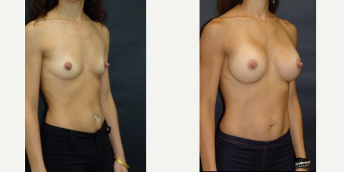 25-34 year old woman treated with Breast Implants