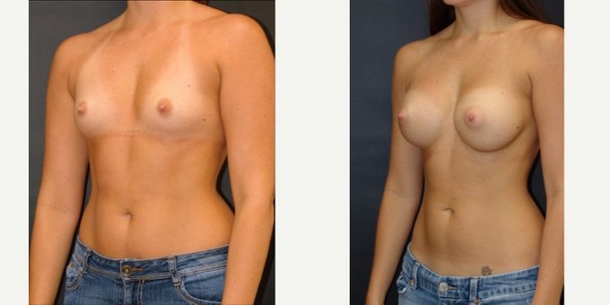 Woman treated with Breast Implants