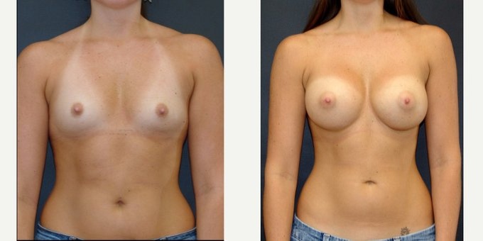 Woman treated with Breast Implants