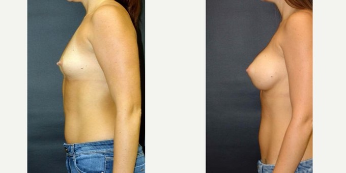 Woman treated with Breast Implants