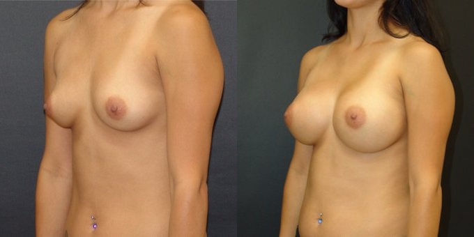 Woman treated with Breast Implants