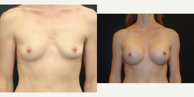 Woman treated with Breast Implants