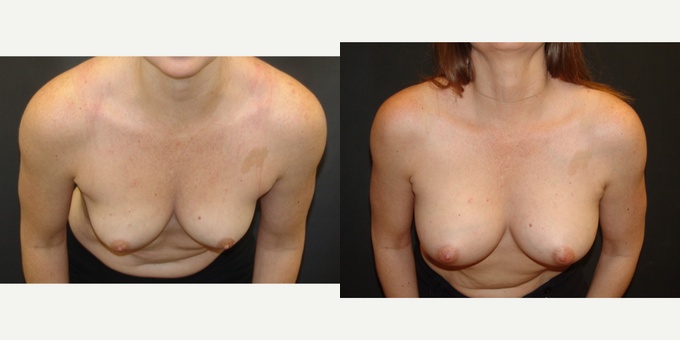 Woman treated with Breast Implants