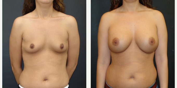 Woman treated with Breast Implants