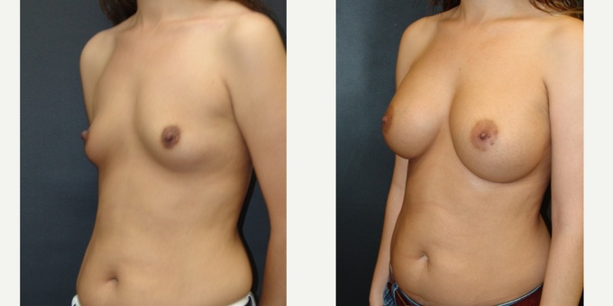 Woman treated with Breast Implants