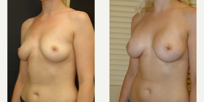 Woman treated with Breast Implants