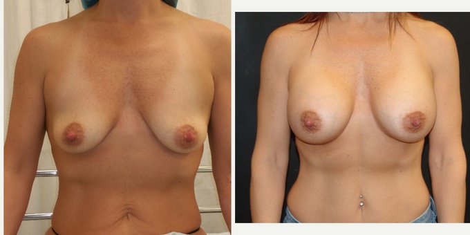 Woman treated with Breast Implants
