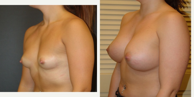 Woman treated with Breast Implants