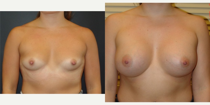 Woman treated with Breast Implants