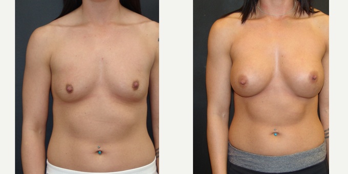 Woman treated with Breast Implants