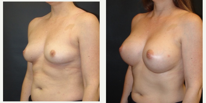 Woman treated with Breast Implants