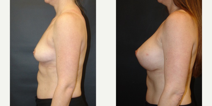 Woman treated with Breast Implants