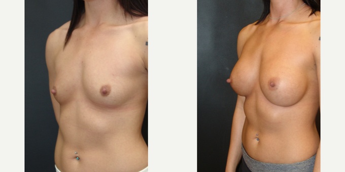 Woman treated with Breast Implants