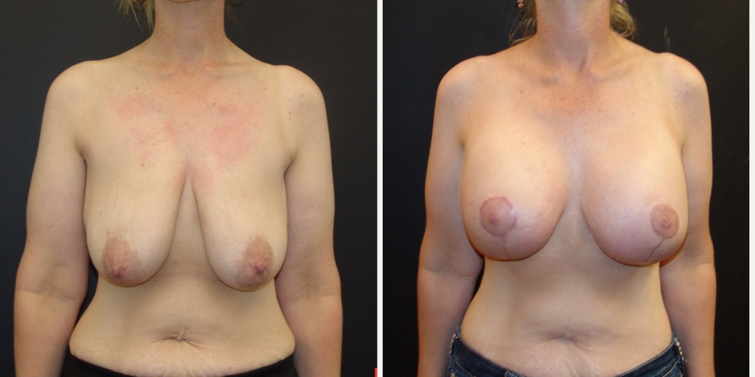 Woman treated with Breast Lift With Implants