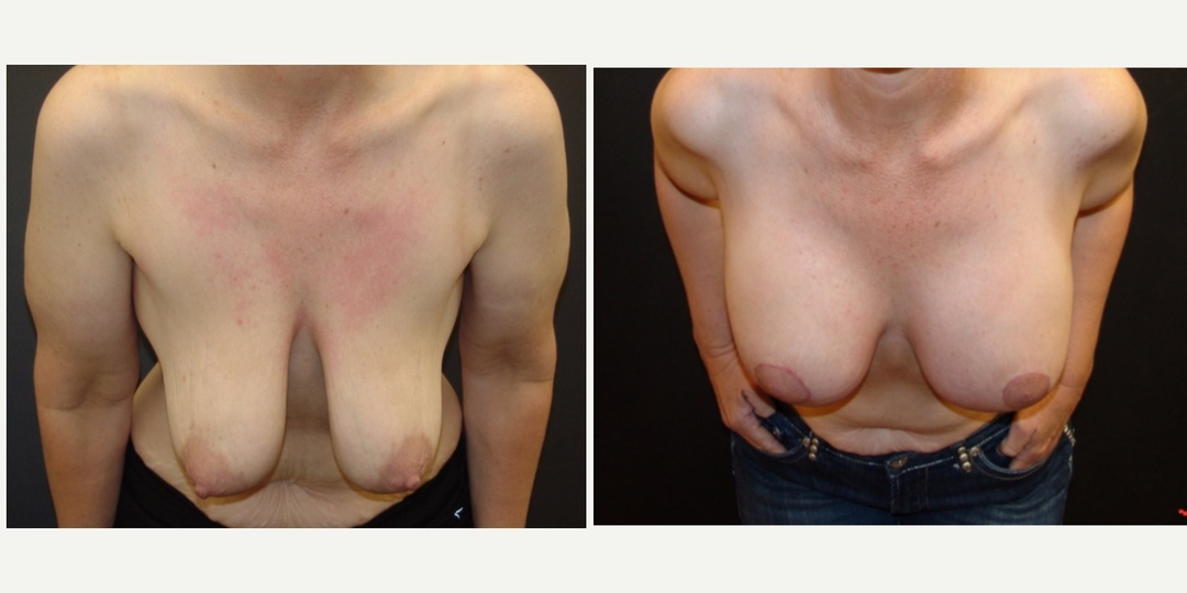 Woman treated with Breast Lift With Implants