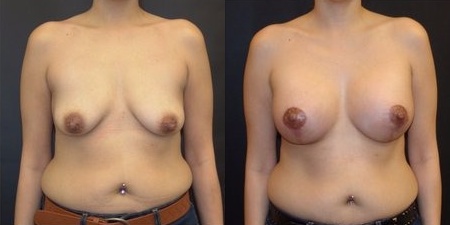 Woman treated with Breast Lift With Implants