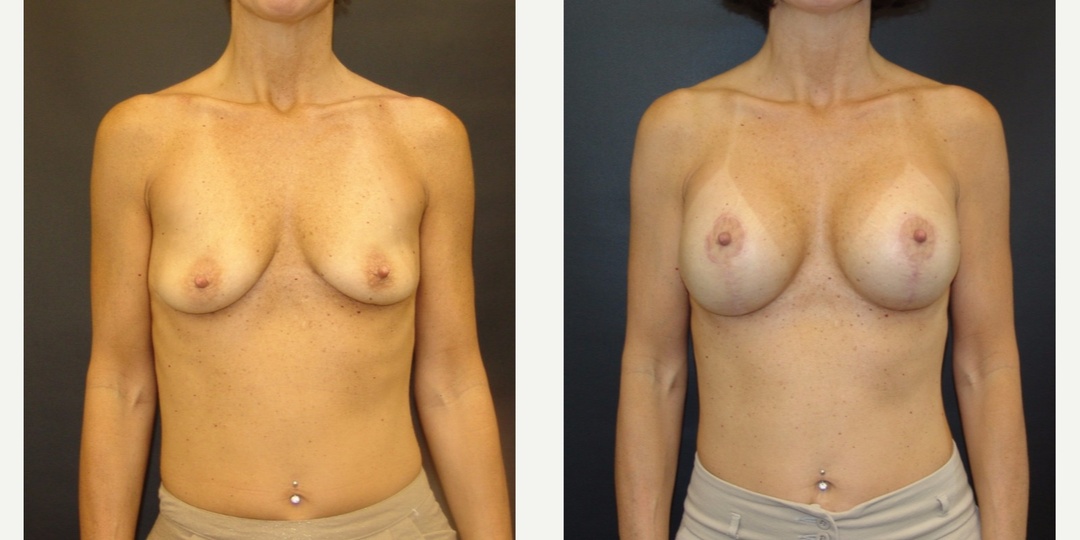Woman treated with Breast Lift With Implants
