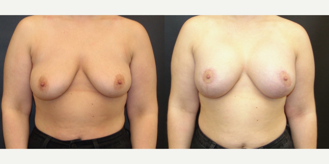 Woman treated with Breast Lift With Implants