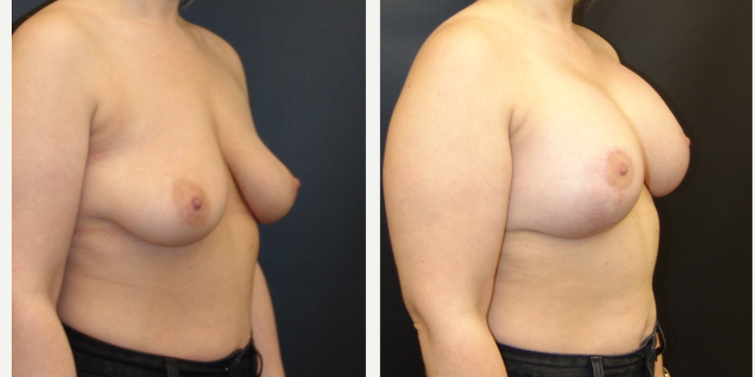 Woman treated with Breast Lift With Implants